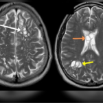 Hombre acude al hospital por migraña; le encuentran larvas en el cerebro